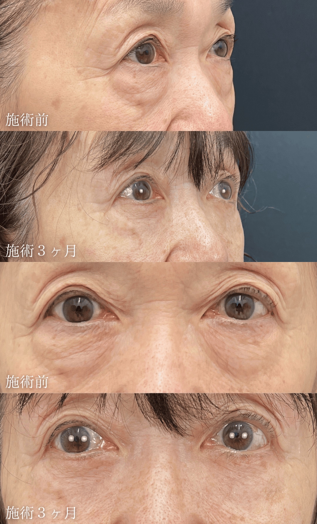 70代女性「ふくらみと皮膚の小じわ、両方気になる」